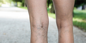 Legs with poor circulation